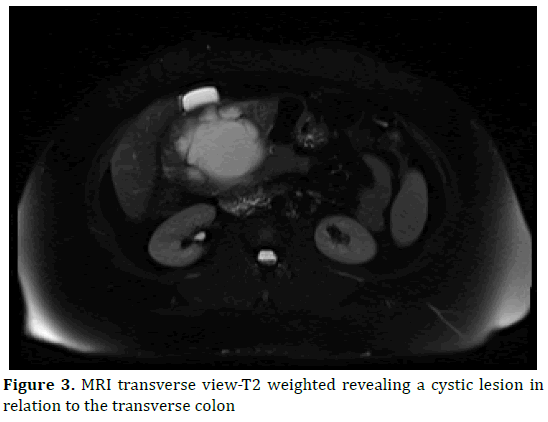 pancreas-transverse-cystic-lesion