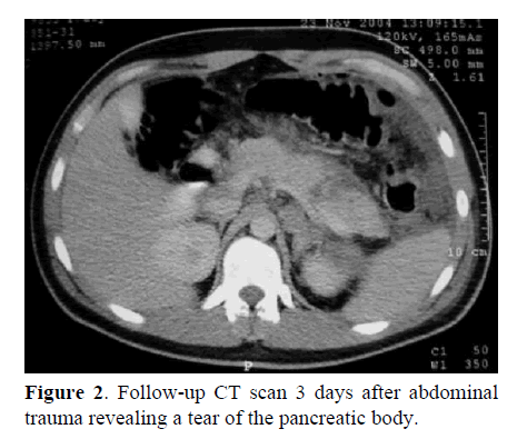 pancreas-trauma-revealing-tear