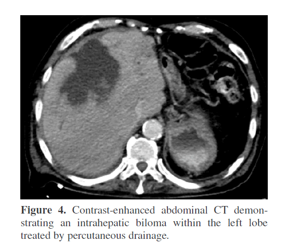 pancreas-treated-percutaneous-drainage