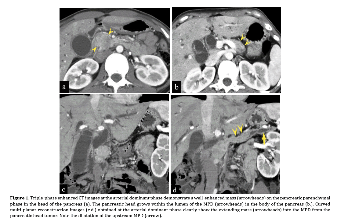 pancreas-triple-phase-enhanced-CT