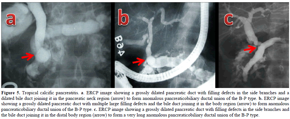 pancreas-tropical-calcific-grossly