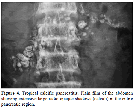 pancreas-tropical-calcific-pancreatitis