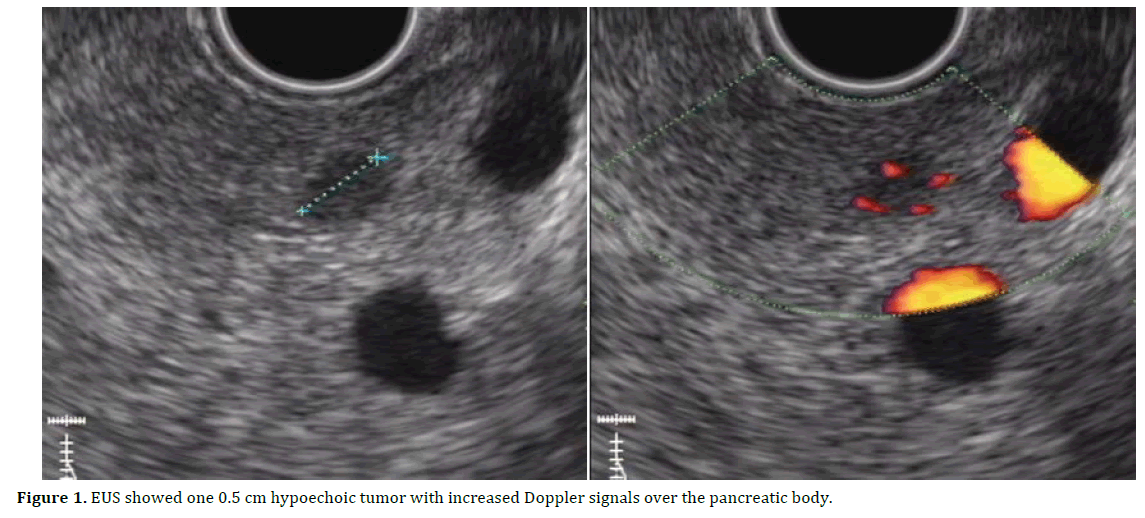 pancreas-tumor