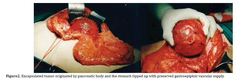 pancreas-tumor