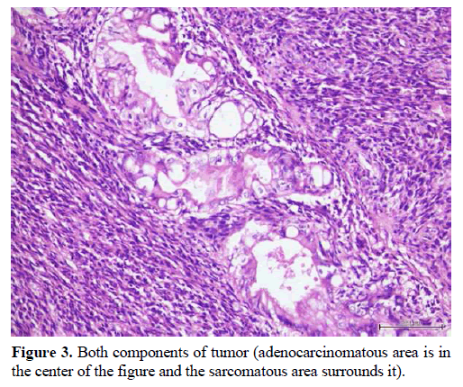 pancreas-tumor-adenocarcinomatous-sarcomatous