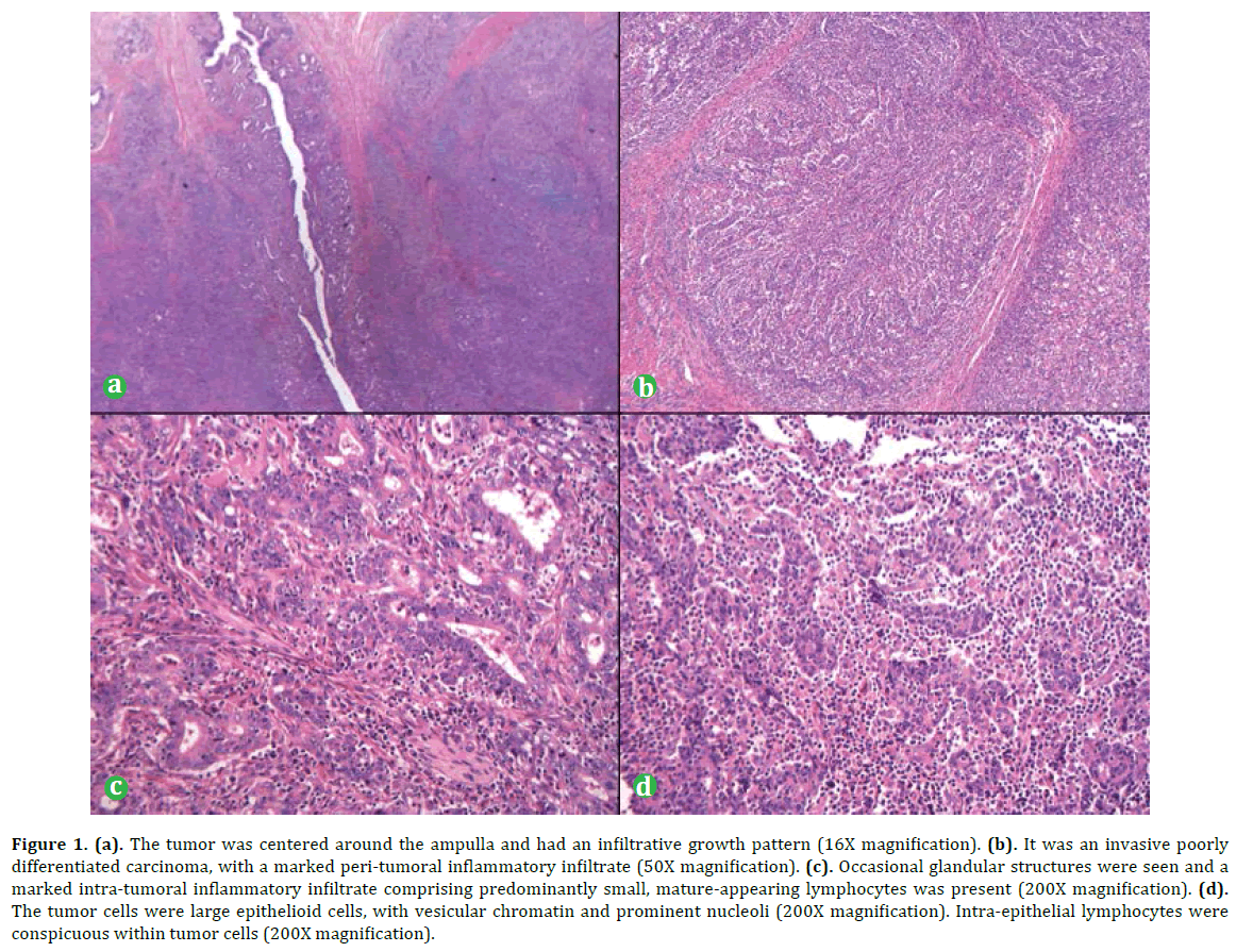 pancreas-tumor-centered-ampulla