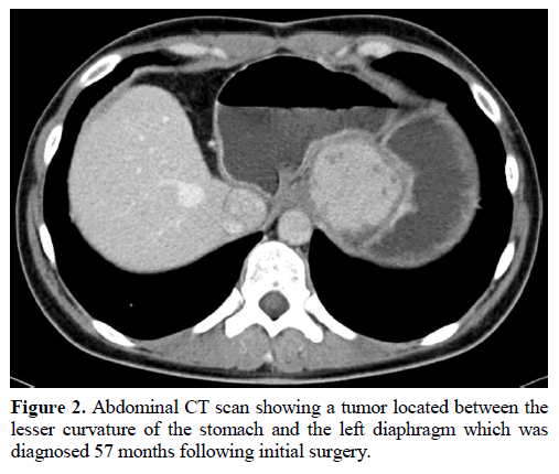pancreas-tumor-diaphragm-diagnosed