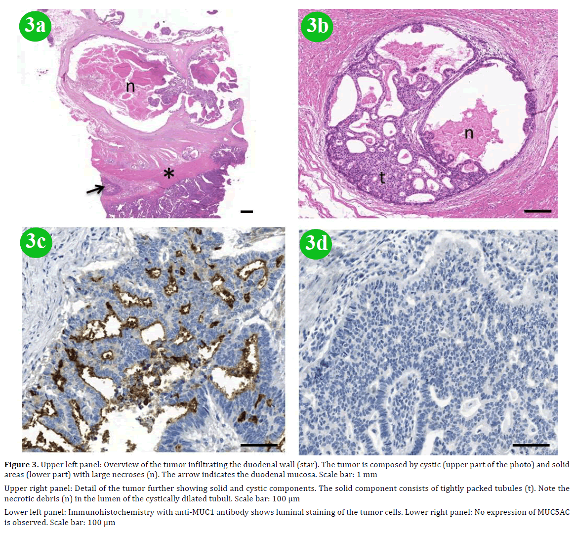 pancreas-tumor-duodenal-wall