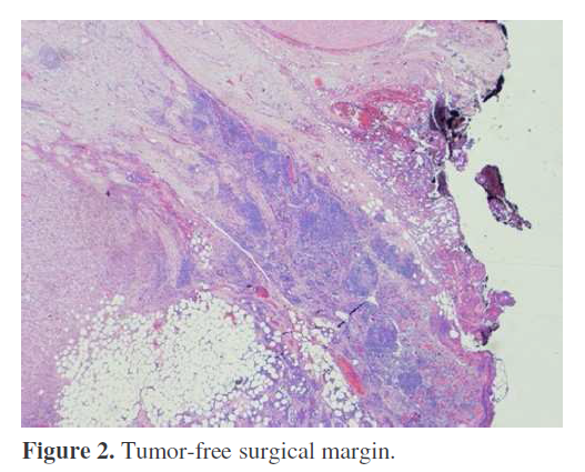 pancreas-tumor-free-surgical-margin