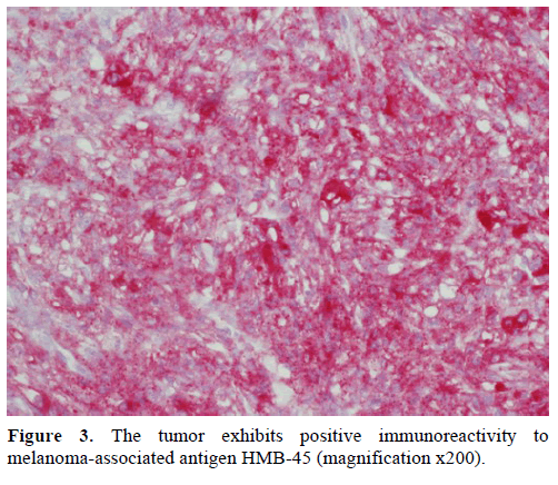 pancreas-tumor-melanoma-associated-antigen