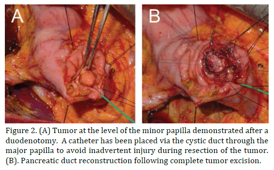 pancreas-tumor-papilla-demonstrated