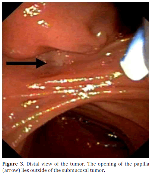 pancreas-tumor-papilla-submucosal