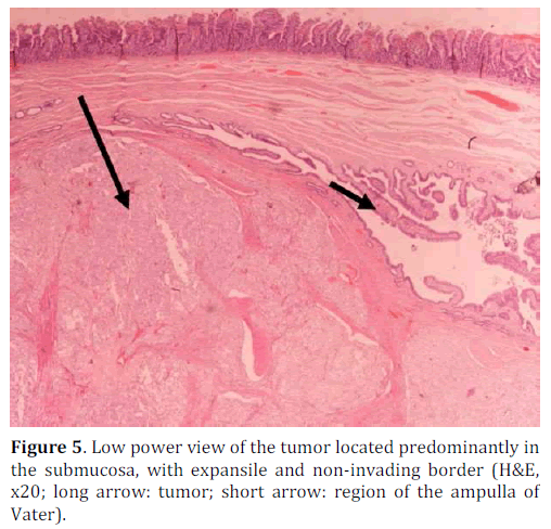 pancreas-tumor-predominantly-submucosa