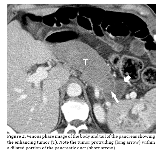 pancreas-tumor-protruding