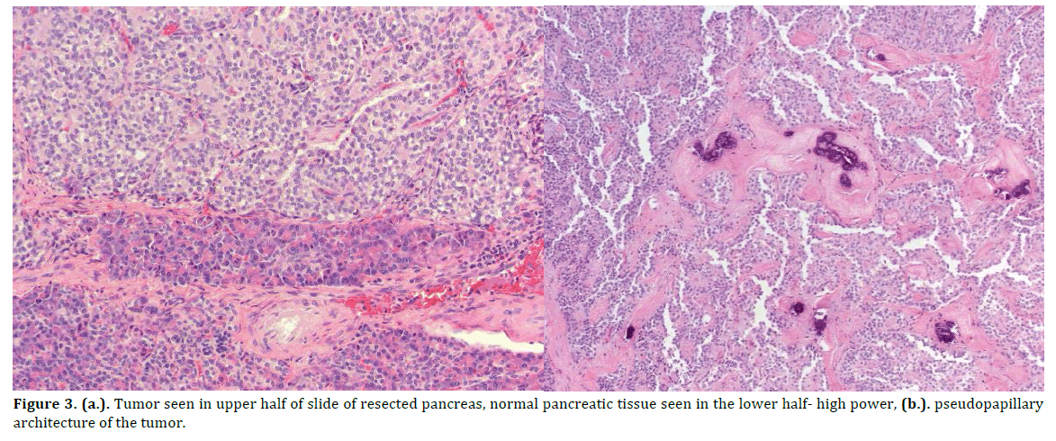 pancreas-tumor-resected-pancreas
