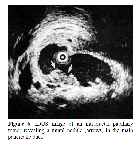 pancreas-tumor-revealing-mural-nodule