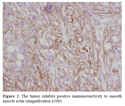 pancreas-tumor-smooth-muscle-actin