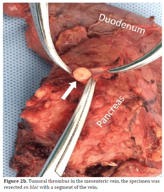 pancreas-tumoral-thrombus-vein