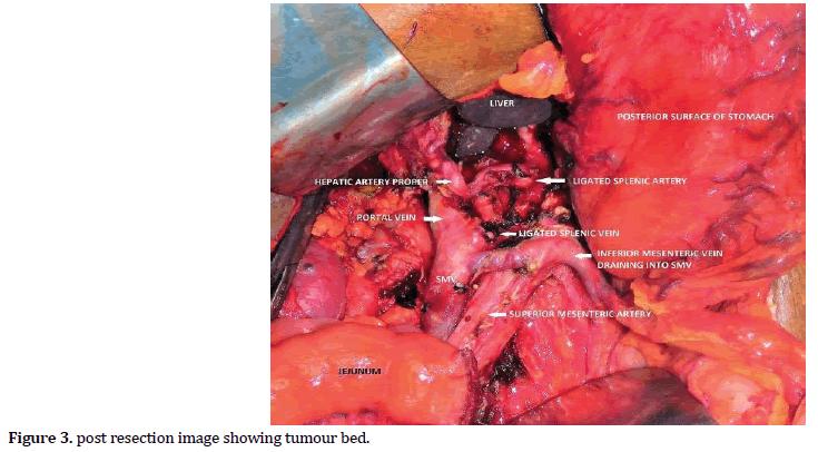pancreas-tumour-bed
