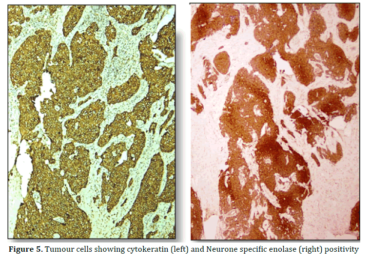 pancreas-tumour-cells-cytokeratin