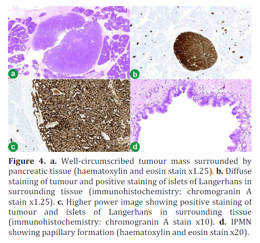 pancreas-tumour-pancreatic-tissue