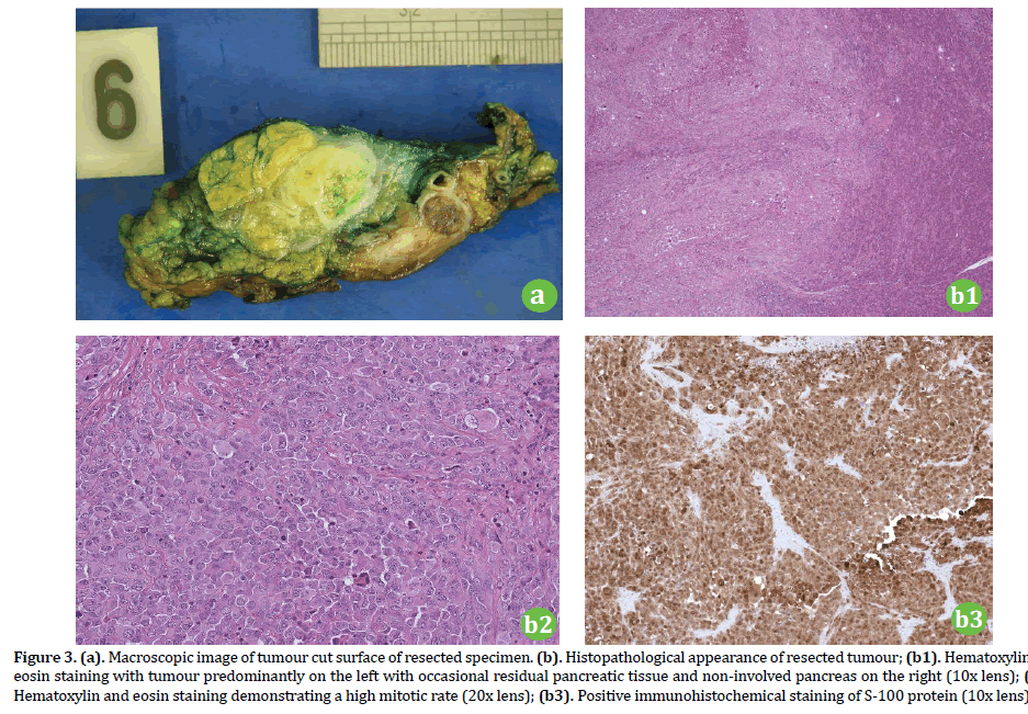 pancreas-tumour-predominantly