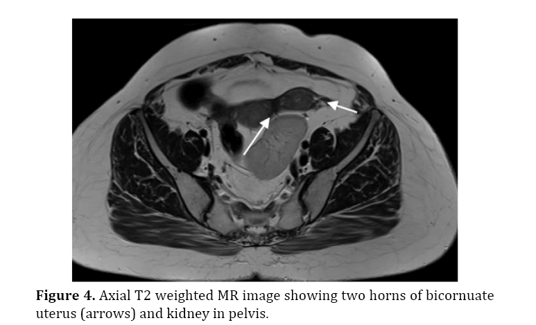 pancreas-two-horns-bicornuate