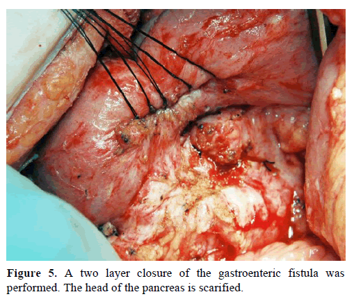 pancreas-two-layer-closure-gastroenteric