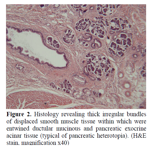 pancreas-typical-pancreatic-heterotopia