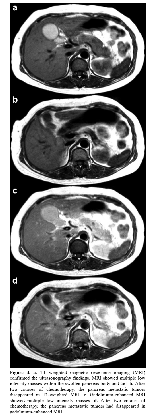 pancreas-ultrasonography-findings
