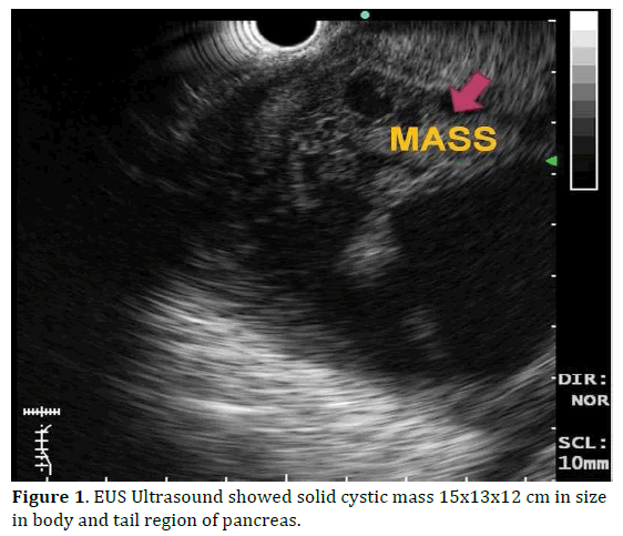 pancreas-ultrasound-cystic-mass