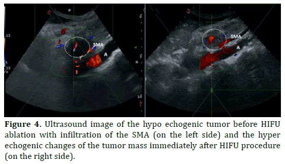 pancreas-ultrasound-echogenic-tumor
