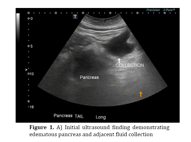 pancreas-ultrasound-finding-demonstrating