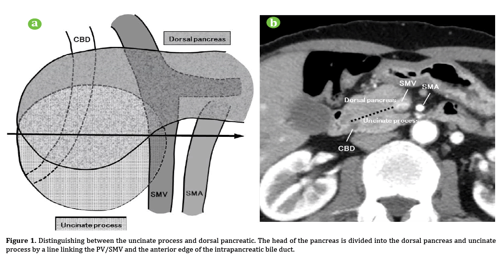 pancreas-uncinate