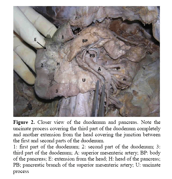 pancreas-uncinate-process-covering