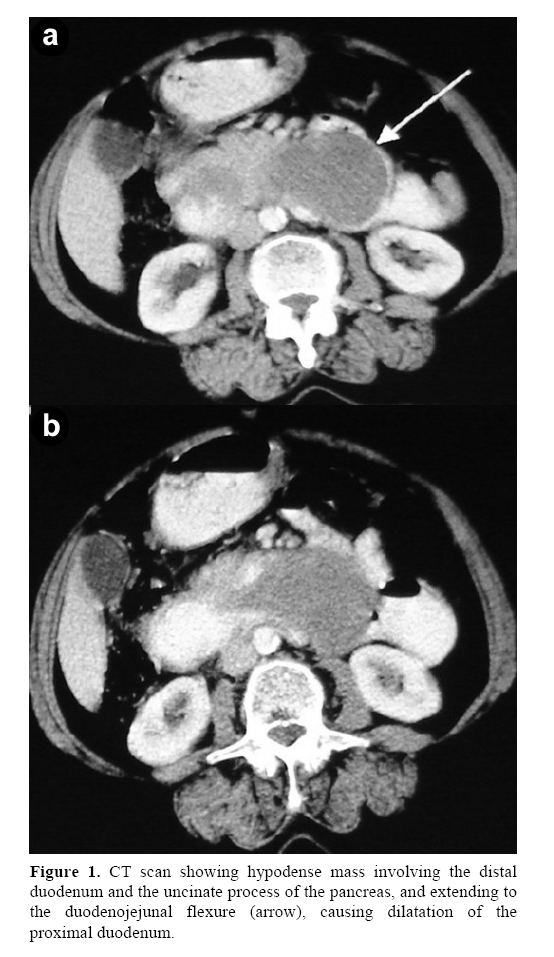 pancreas-uncinate-process-pancreas