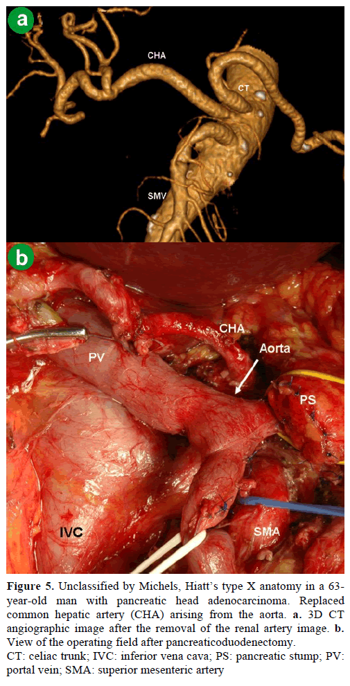 pancreas-unclassified-michels-hiatt-anatomy