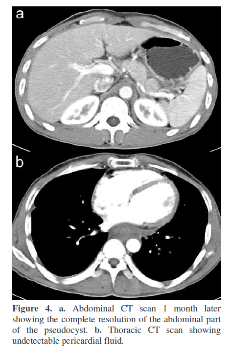 pancreas-undetectable-pericardial-fluid