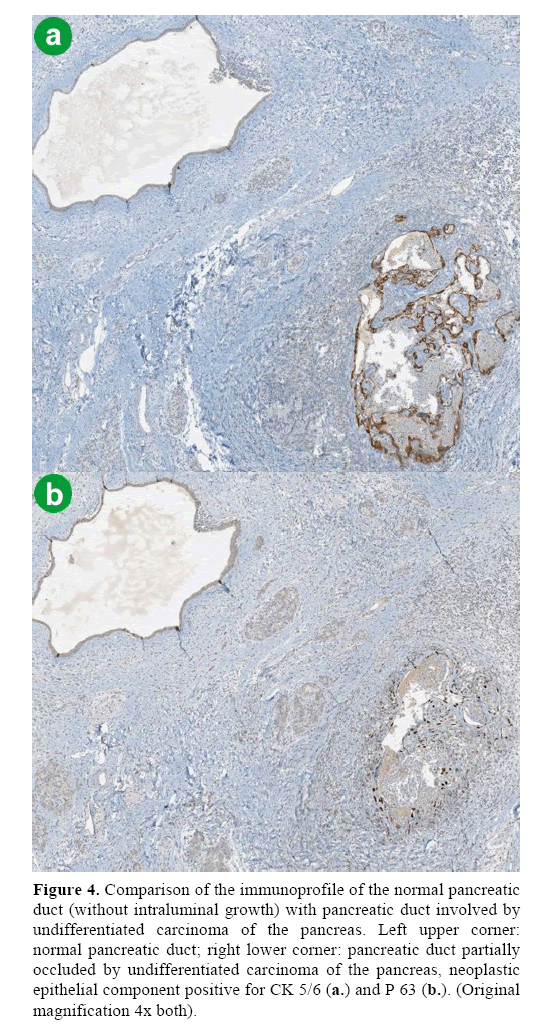 pancreas-undifferentiated-carcinoma