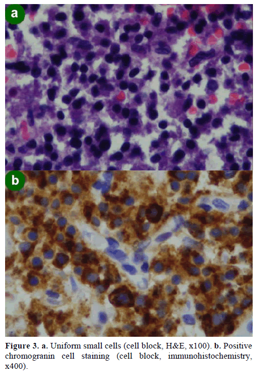 pancreas-uniform-small-cells-chromogranin