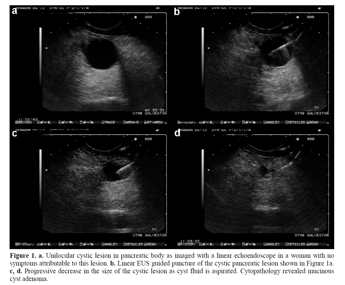 pancreas-unilocular-cystic-lesion