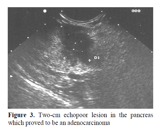 pancreas-unilocular-echopoor-lesion