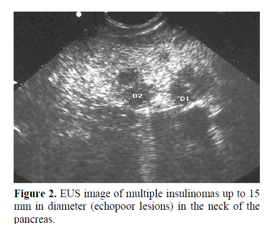 pancreas-unilocular-multiple-insulinomas