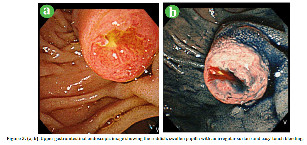 pancreas-upper-gastrointestinal-endoscopic
