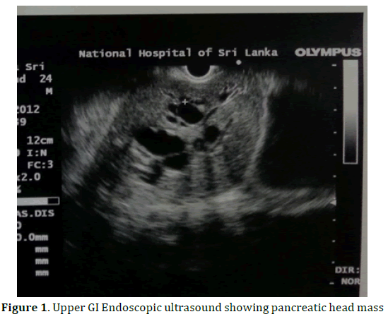 pancreas-upper-gi-endoscopic-ultrasound