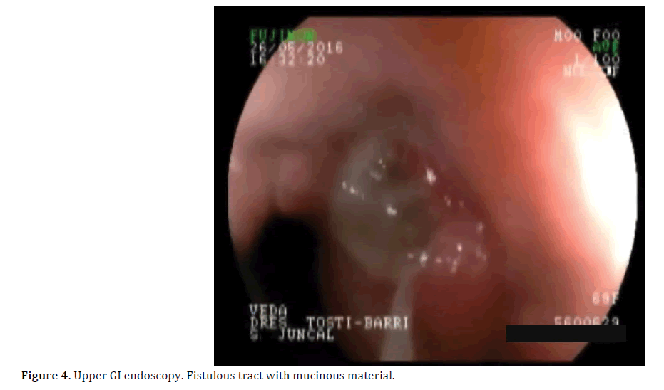 pancreas-upper-gi-endoscopy-mucinous