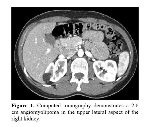 pancreas-upper-lateral-aspect