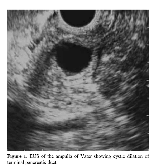 pancreas-vater-showing-cystic