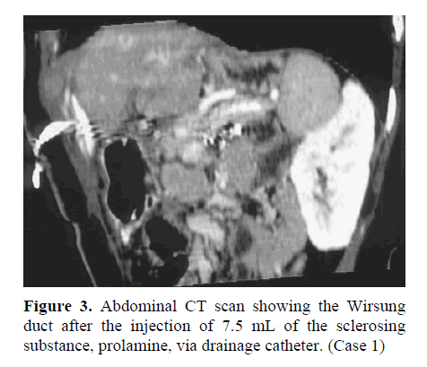 pancreas-via-drainage-catheter