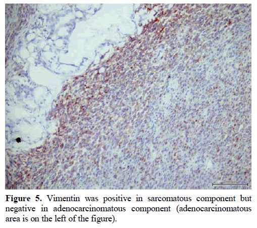 pancreas-vimentin-adenocarcinomatous